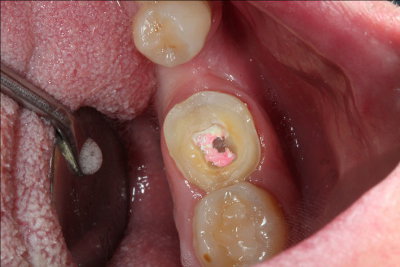 Caso práctico de endodoncia. Clínica Dental Fernández León