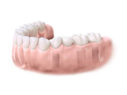 Implantes dentales. Clínica Dental Fernández León