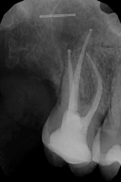 Radiografía de un diente endodonciado. Clínica Dental Fernández León